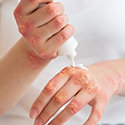 Psoriasis Medicine